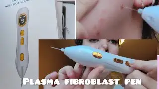 plasma fibroblast pen - alternative to Dermavel - review !