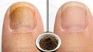 Nail fungus treatment at home | Nail whitening at home | Say GOODBYE to Nail Fungus with Clove Packs
