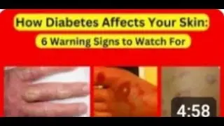 6 Hidden Skin Signs of Diabetes | Diabetes skin signs | Diabetes symptoms | ZeroDiabetes Zone