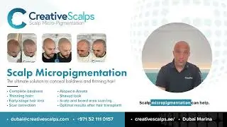 Scalp Micropigmentation - Creative Scalps Dubai