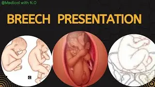 breech presentation , frank breech, footling presentation #breechpresentation @MEDICALwithN.O