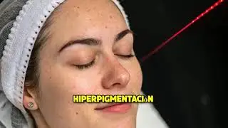 LO QUE NADIE TE CUENTA : Tecnolog&iacute;a Est&eacute;tica Desvelada &ndash; L&aacute;ser CO₂ SmartXide,  Belleza y est&eacute;tica.