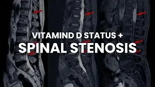 Vitamin D Status and Spinal Stenosis