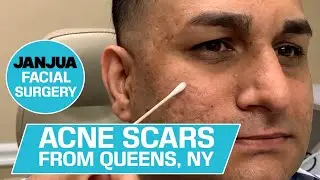 ACNE SCARS FROM QUEENS, NEW YORK - DR. TANVEER JANJUA - NEW JERSEY