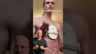 Pigeon Chest Deformity #shorts