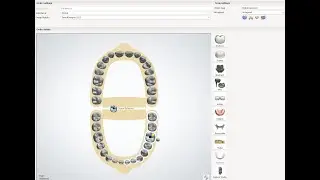 Diseño de una Corona Atornillada en 3shape