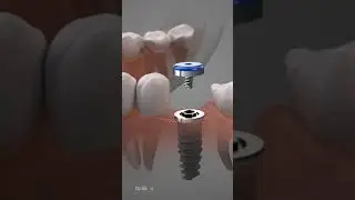 Dental Implants Procedure&nbsp;#animation&nbsp;#surgery&nbsp;#dentist&nbsp;#implant&nbsp;#teeth
