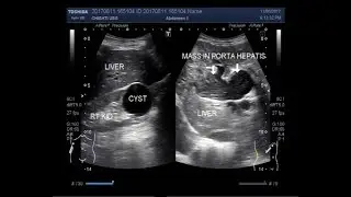 Ultrasound Video showing a Mass in Porta hepatis.