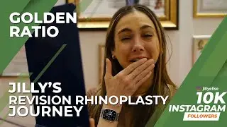 Revision Rhinoplasty Experience (Revision Nose Job)