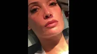 Lip Lift Procedure with Dr. Milgrim Part 2: The Technique