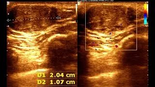 **Ultrasound of a Long-Standing Subcutaneous Back Lump | Likely Epidermoid Cyst**