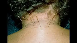 Cervical pain,Back pain ,disc bulge, sciatica pain acupuncture therapy 20/4/2025 live stream agra