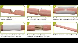 Repairing Nerves: Orthocell's story, with CEO Paul Anderson
