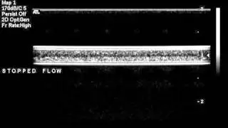 Cintrated blood PE tubing