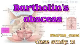 Bartholin's abscess | Marsupialization | #gynic_case_11 | #PharmD_cases