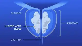 Loyola Minute: Benign Prostatic Hyperplasia or BPH