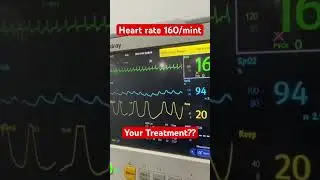 Heart rate more than 160 / mint | What is your plan of treatment#foryou #hospital #cardiacarrest#for