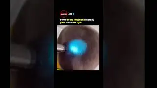 Why This Person&rsquo;s Head is Glowing Under UV Light