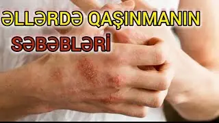 Əllərin ŞİDDƏTLİ QAŞINMASININ səbəbləri