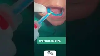 Open Tray impression for dental implants, Dyna Dental Implants
