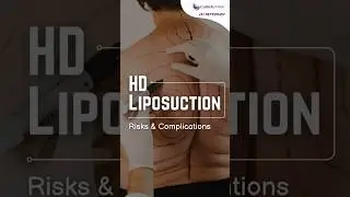 Seroma Prevention & Recovery After HD Liposuction | Dr. Rushin Thakor | Callisto Clinic Surat