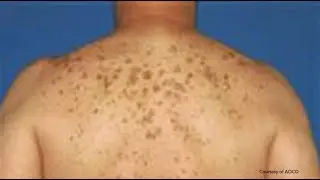 Lentigines age spots And post acne marks (changes left after Pimples heals)