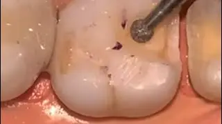 MB2 Canal in Upper first molar