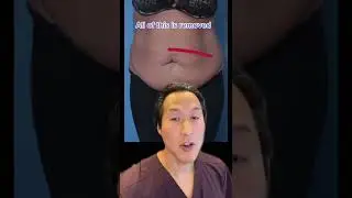 Watch This Tummy Transformation! #shorts #tummytuck