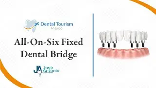 All on Six Fixed Bridge (Full Mouth Dental Implants) Los Cabos - Dental Tourism Mexico