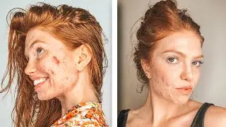 HOW SHE STAYS POSITIVE WITH SEVERE ACNE | @Alexandra_Breeze Interview