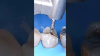 Diamond bur with depth guide for tooth... #toothpr #rubberdam #odontologia #dentalstudents