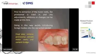 Dr. Shuman on LuxaCrown