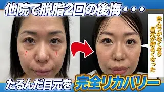 【クマ取り】「2度の脱脂施術からついに理想の肌へ！色ムラ解消で若返り成功✨#岡山 #美容クリニック #クマ取り #脱脂
