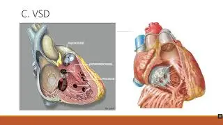 Truncus arteriosus - Dr Ahmed Osman