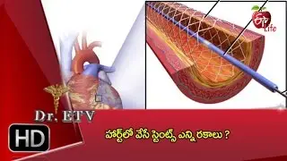 Dr.ETV - Types of stents in heart - 6th August 2016 - డాక్టర్ ఈటివీ