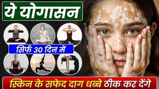 सफ़ेद दाग के लिए योगा | vitiligo yoga | white spots recovery yoga | White patches recovery yoga