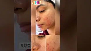&lrm;🧏&zwj;♀️ Pure Skin Acne & Pimples Toner / Face Wash 🧏&zwj;♂️ #shorts