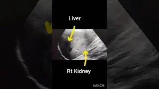 Ultrasound Abdomen! Normal Liver and kidney Scan!#ultrasoundmadeeasy86#radiology