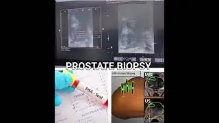 PROSTATE BIOPSY MRI and Ultrasound Fusion -Guided - Latest technology to detect prostate cancer