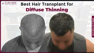 Best Hair Transplant for Diffuse Thinning | Norwood 5A Results at 1 Year