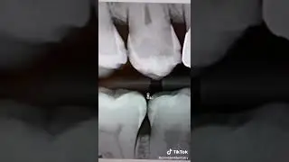 Как выглядит кариес на рентгеновском снимке? #шорты