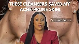 5 Cleansers I Swear By For Acne-Prone Skin (and Won&rsquo;t Ruin Your Skin Barrier)