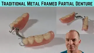 Close up look at a traditional metal framed partial denture