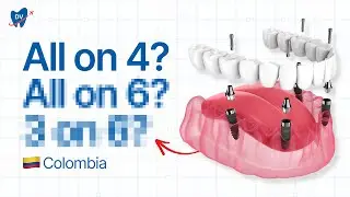 Full Mouth Dental Implants in Bogota (Here&rsquo;s How Much You Can Save in Colombia)