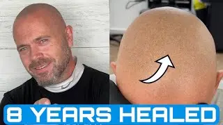 Real Healed SMP Results | 8 Years After Scalp Micropigmentation