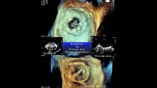 Mitral bileaflet vs tilting disc prosthetic valve/ 3D TEE image