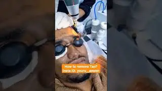 Wow...TAN Removal Laser treatment ❣️❣️❣️ #ameerht