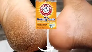 I PUT BAKING SODA ON MY FEET AND LOOK WHAT HAPPENED | SHOCKING RESULTS