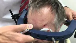 HALO brace removal
