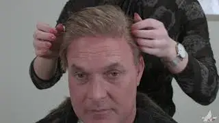 hairloss MacHair Amsterdam hairreplacement hairsolutions men alopecia totalis baldnes contactskin th